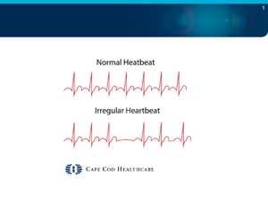 Arrhythmias