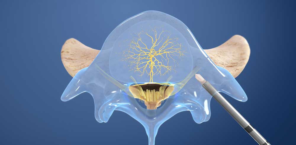 Relievant Intracept Benefits