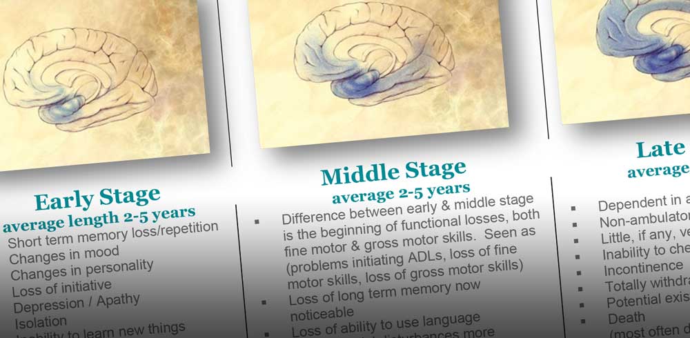 Download: Alzheimer’s Stages & Intervention [PDF]