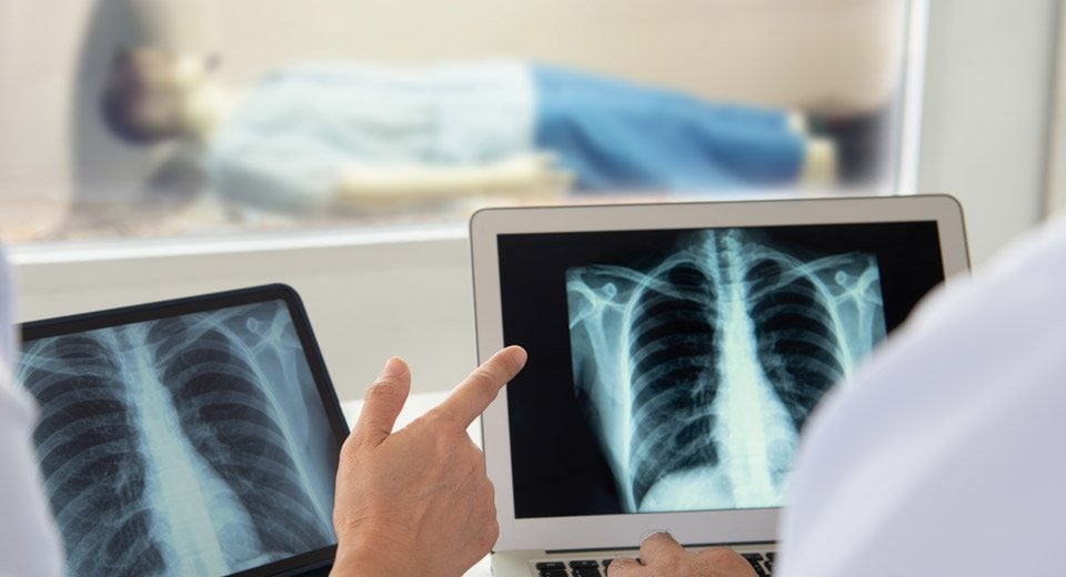 Should you get screened for lung cancer? The answer may surprise you