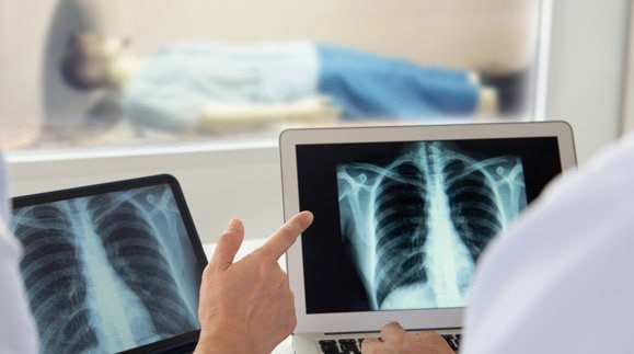 Should you get screened for lung cancer? The answer may surprise you